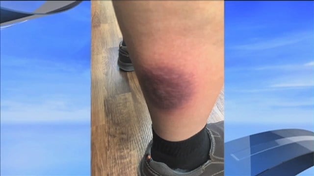 michigan-man-recovering-from-brown-recluse-spider-bite-wnem-tv-5